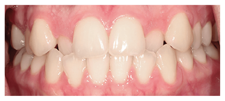 Before Six Month Smiles Treatment at Dental Touch