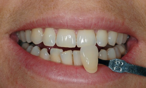British dental association teeth whitening