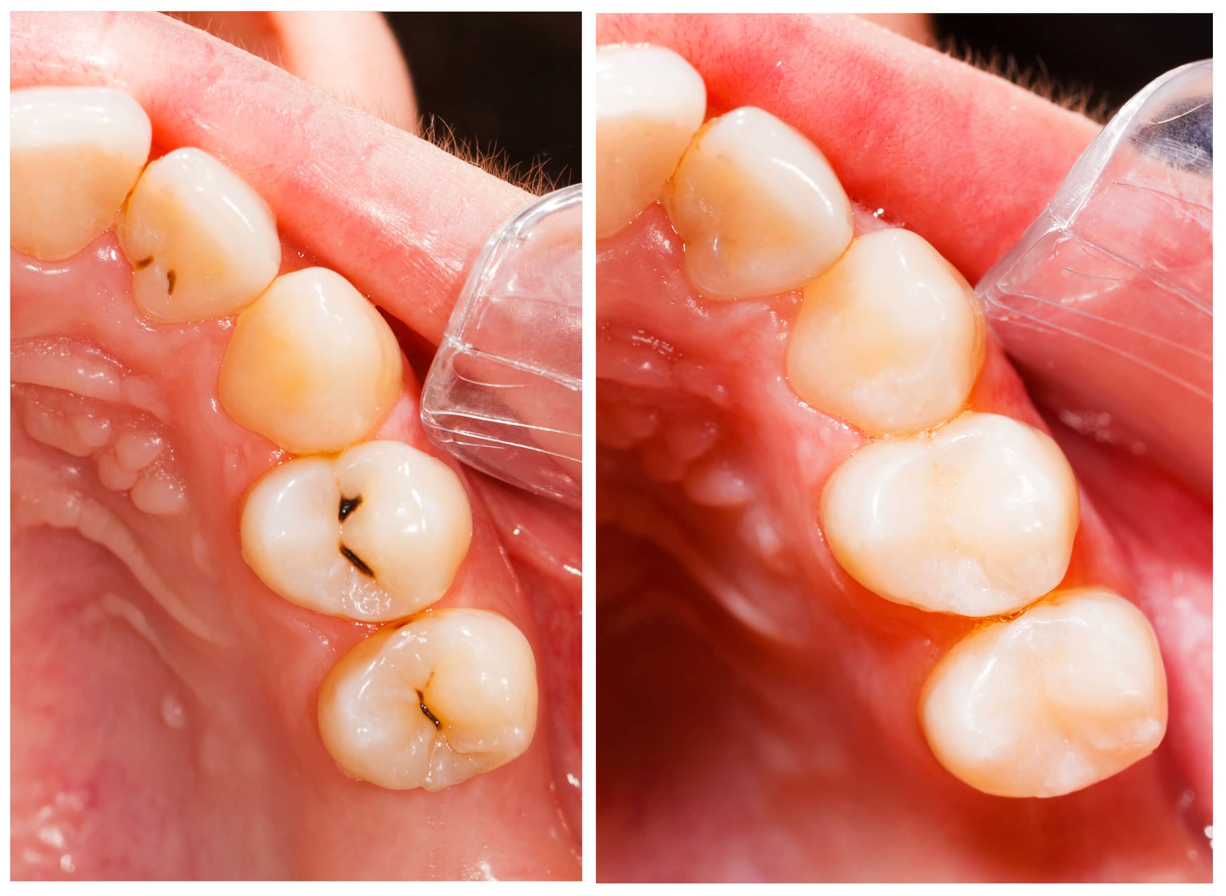 Dental Fillings In Bristol Dental Fillings In Bristol
