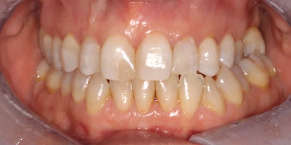 After Cosmetic in Bristol After Cosmetic in Bristol