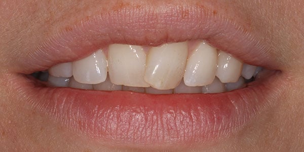Before Braces Before Braces