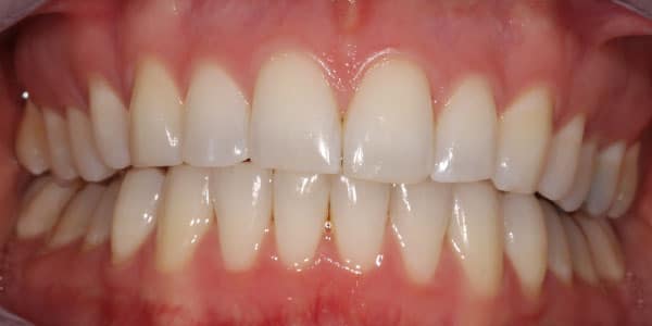After Braces After Braces