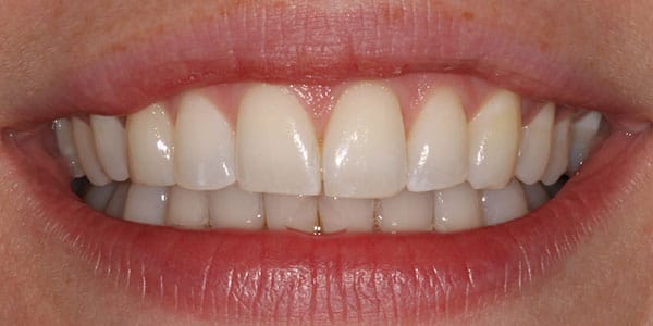 Happy Patient with dental implants bristol
