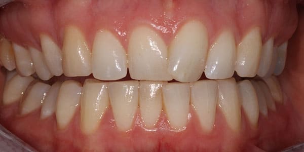 Before Braces Before Braces
