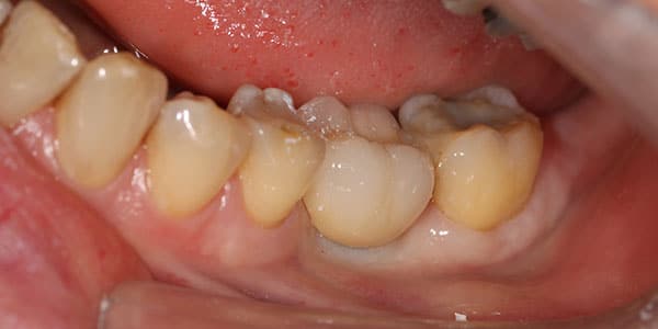 Bristol dental implant dentist replace missing tooth Missing back tooth replaced with an Dentist implants