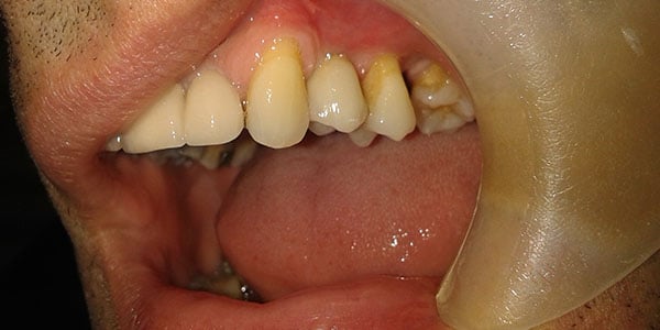 After Dental Implants in Bristol