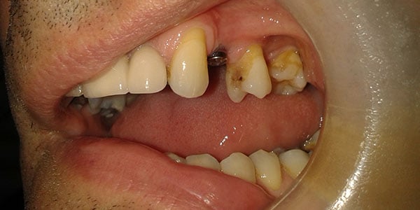 Before Dental Implants in Bristol