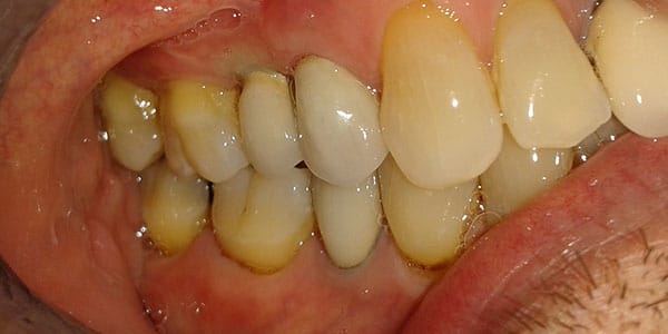 After Dental Implants in Bristol After Dental Implants in Bristol