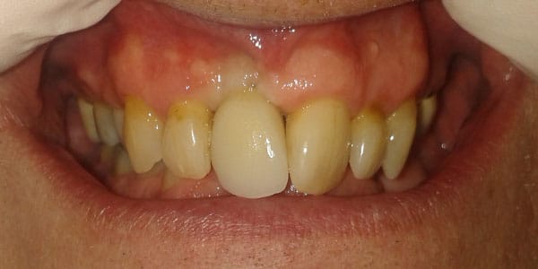 After Dental Implants in Bristol After Dental Implants in Bristol