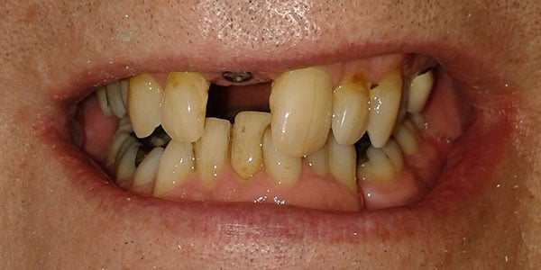 Before Dental Implants in Bristol