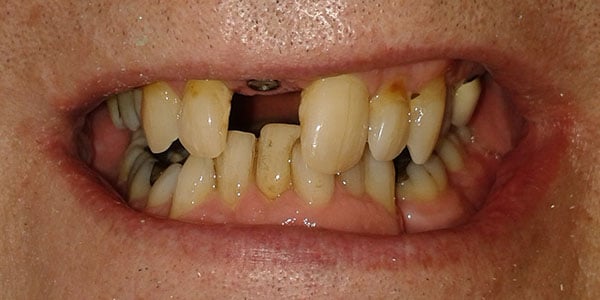 Before Dental Implants in Bristol Before Dental Implants in Bristol