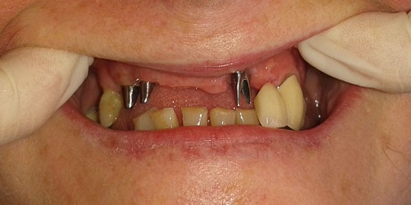 Missing Multiple front teeth Bristol Patient missing multiple front teeth