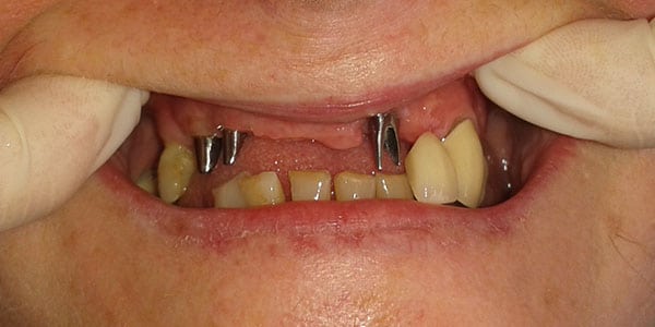 Before Dental Implants in Bristol