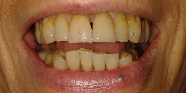 After Dental Implants in Bristol