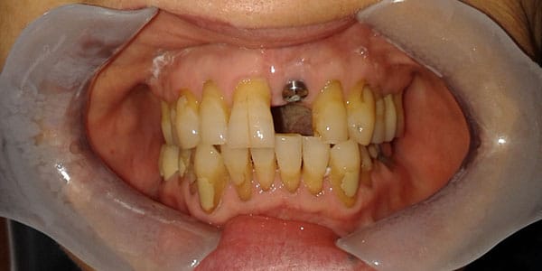 Before Dental Implants in Bristol Before Dental Implants in Bristol