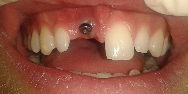 Before Dental Implants in Bristol Before Dental Implants in Bristol