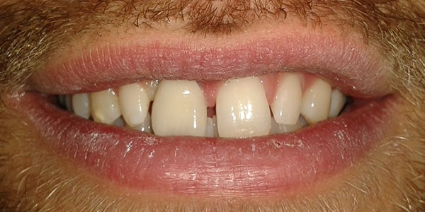After Dental Implants in Bristol After Dental Implants in Bristol