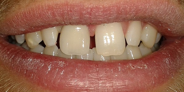 After Dental Implants in Bristol After Dental Implants in Bristol