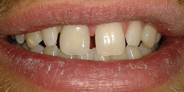 After Dental Implants in Bristol