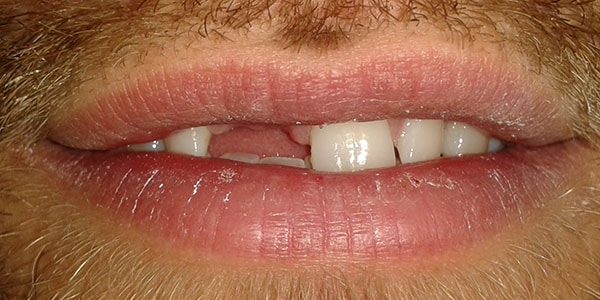Before Dental Implants in Bristol Before Dental Implants in Bristol