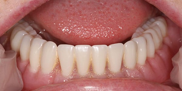 Replace full set of teeth in bottom jaw