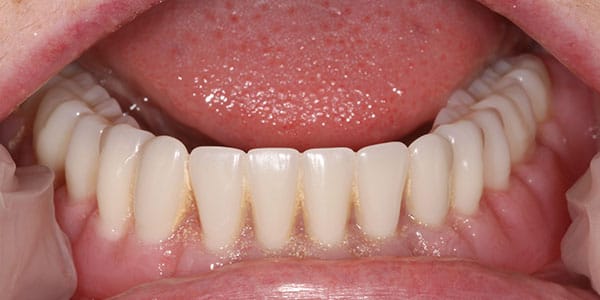 All on 4 Dental implants in bristol Replace full set of teeth in bottom jaw