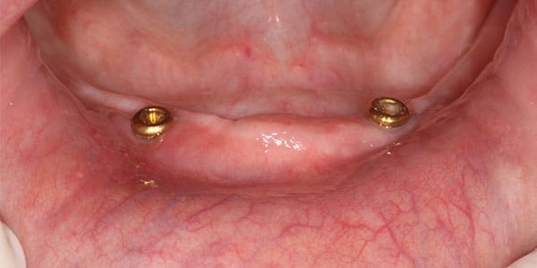 Patients need All on 4 dental implants All missing teeth