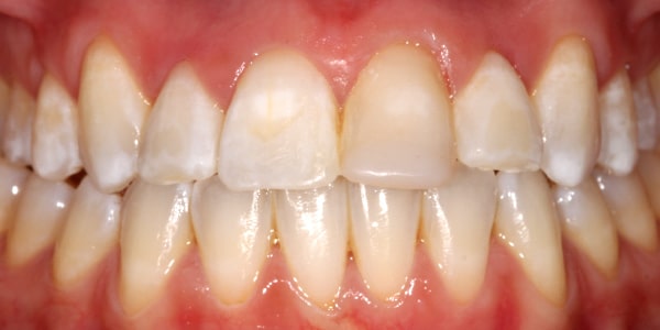 After Braces After Braces