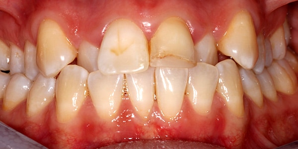 Before Braces Before Braces