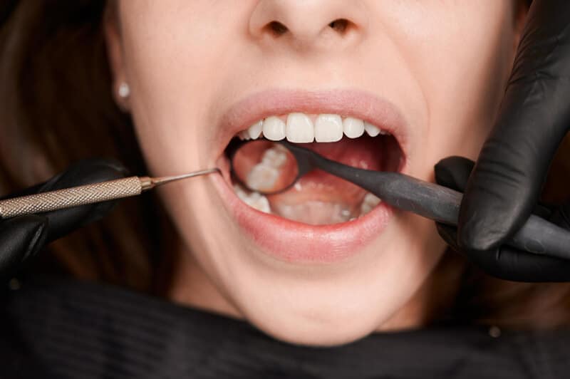 Dental Fillings In Bristol
