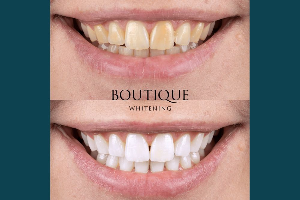 Boutique Teeth Whitening (1) Boutique teeth whitening – Dental Touch Bristol
