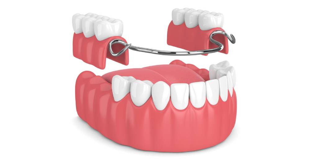 dental-bridges-bristol Dental bridges Bristol – Dental Touch