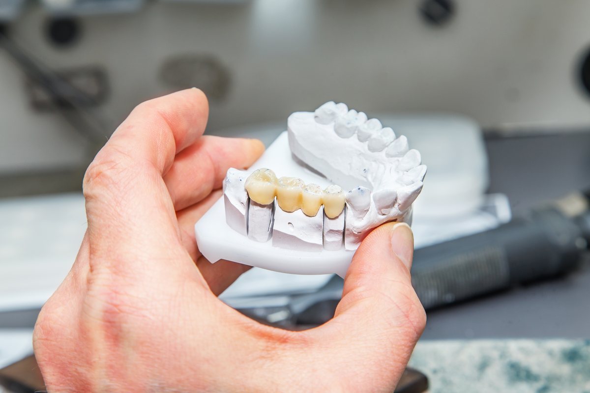 dental-crown-lab-model-bristol Dental crown lab model Bristol – Dental Touch