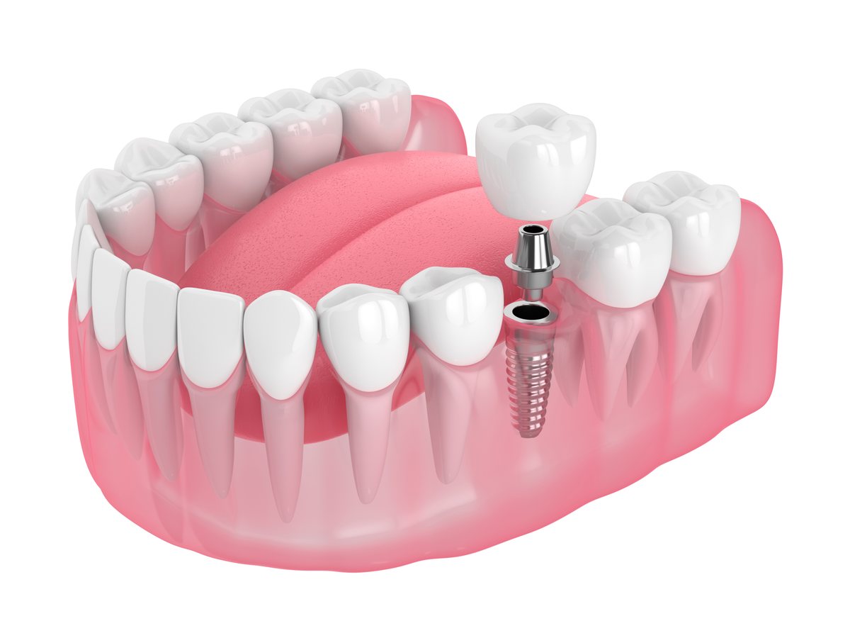 Dental implant abutment Bristol – Dental Touch