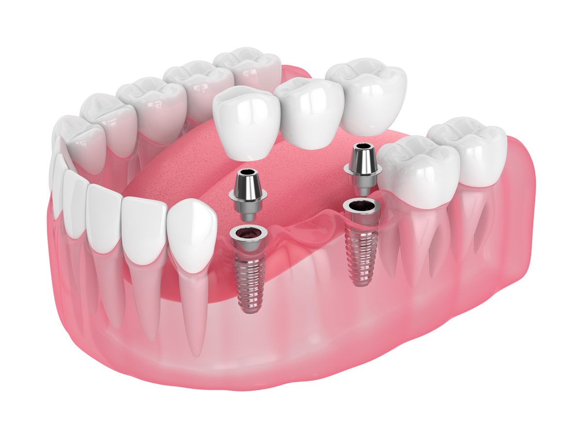 Dental implant crown bridge Bristol – Dental Touch
