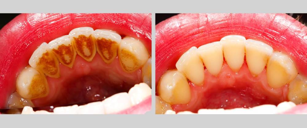 gum-disease-plaque-removal-bristol (2) Gum disease plaque removal Bristol – Dental Touch