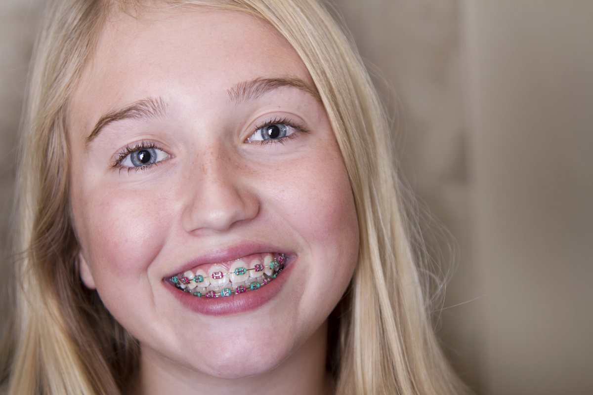 Teen braces teeth straightening Bristol – Dental Touch