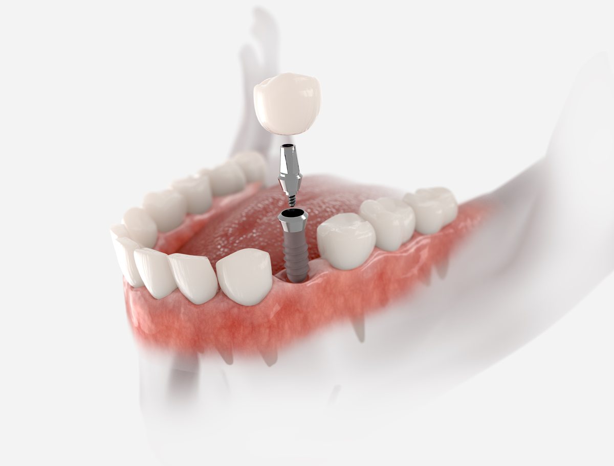 What is dental implant Bristol – Dental Touch